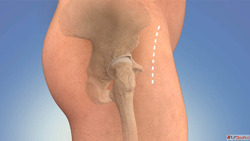 Dr. Ajaysinh Devda - Revision Total Hip Joint Replacement Su...