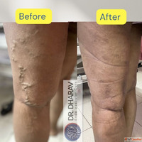 Experienced Vascular Surgeon in Mumbai India - Dr. Dharav Kh...