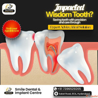 Painless Wisdom Teeth Removal near Secunderabad Telangana