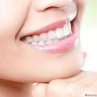 Teeth Whitening Cost in Dubai