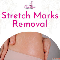 Everything You Need to Know About Removal Stretch Marks For ...