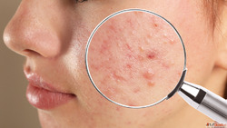 Restore Skin Balance with Homeopathy Treatment in Gaur City