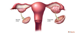 Hormonal Balance with Homeopathy Treatment for PCOS