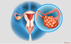 Effective Treatment for PCOD In pune