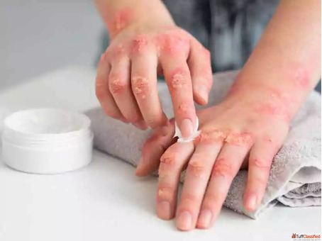 Psoriasis Treatment in Pune