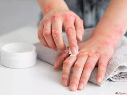 Psoriasis Treatment in Pune