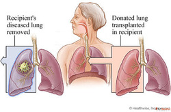 Lung Transplant Cost in India - In Best Hospitals HOSPIDIO