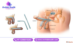 Best Penile Implant Surgery in Bangalore - Orchidz Health