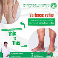 Varicose Veins Treatment Cost - Factors Options Pricing Guid...