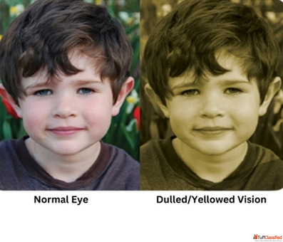 Restore Clear Vision with Advanced Cataract Surgery at Mahajan Eye Centre Delhi