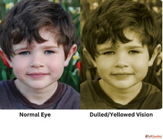 Restore Clear Vision with Advanced Cataract Surgery at Mahaj...