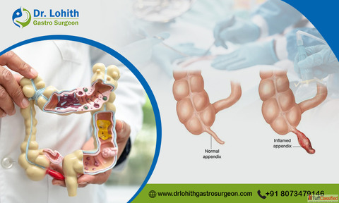 Best Laparoscopic Appendix Surgery in Bangalore - Dr. Lohith U
