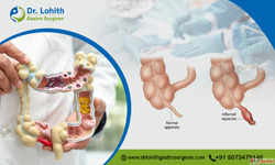 Best Laparoscopic Appendix Surgery in Bangalore - Dr. Lohith...