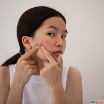 Acne Scar Treatment in Mumbai Restore Smooth Clear Skin with Confidence