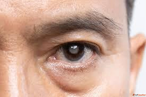 Cataract Surgery at Mahajan Eye Centre Delhi Advanced Eye Care for Clear Vision