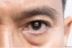 Cataract Surgery at Mahajan Eye Centre Delhi Advanced Eye Ca...