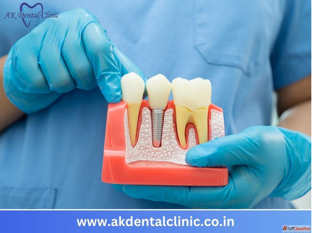 Trusted Dental Implant in Vile Parle Mumbai AK Dental Clinic