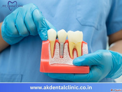 Trusted Dental Implant in Vile Parle Mumbai AK Dental Clinic