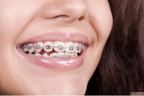 Dental Implants in Delhi NCR