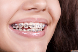 Dental Implants in Delhi NCR