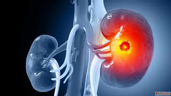 Kidney Cancer Surgery Cost in Coimbatore