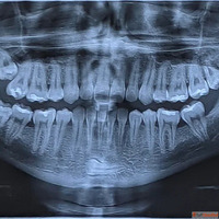 Dental Panoramic X-Ray in Dubai