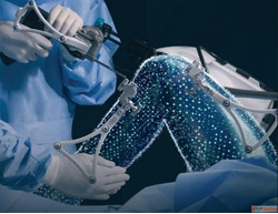 Robotic-Assisted Total Knee Replacement in Ahmedabad by Dr. ...
