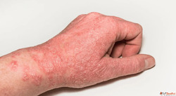 Best Homeopathic Remedies For Eczema - Rise And Shine Medica...