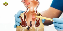 Top-Rated Fissure Treatment in Delhi by Experienced Speciali...