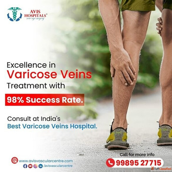 Best Varicose Veins Hospital in Hyderabad