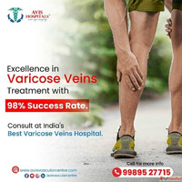 Best Varicose Veins Hospital in Hyderabad