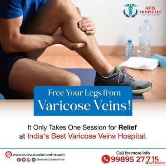 Best Varicose Veins Hospital in Hyderabad
