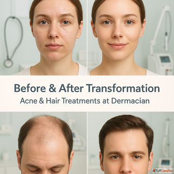 Hair Transplant Myths You Should Stop Believing - Expert Advice from Dermacian