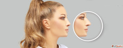 Why Celebrity Nose Jobs Are So Popular All You Need to Know