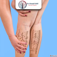 Advanced Varicose Veins Treatment in Ahmedabad - Dr. Krunal ...