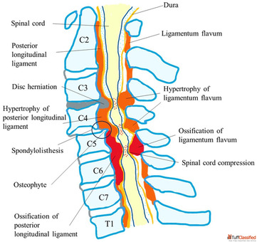 Cervical Spine Surgery by Dr. B. Leela Prasad