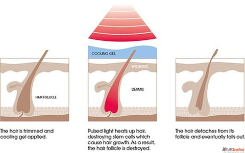 IPL Hair Removal in Kingston Ontario