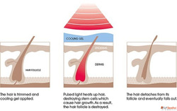 IPL Hair Removal in Kingston Ontario