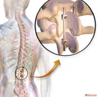 Top Hospitals for Spinal Fusion India