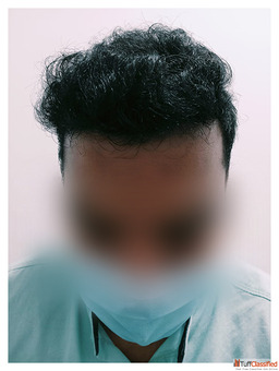Looking for the Best Hair Care Clinic in Coimbatore