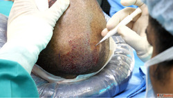 Searching for the Best Hair Clinic in Thrissur