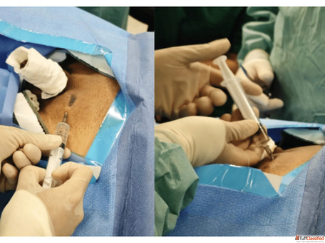 Advanced Varicose Veins Laser Treatment in Pune for Quick Recovery