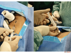 Advanced Varicose Veins Laser Treatment in Pune for Quick Re...