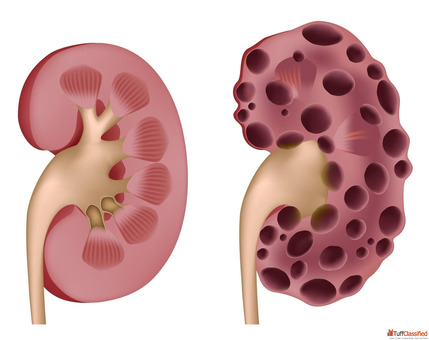 What Size Makes a Kidney Cyst Concerning