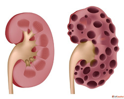 What Size Makes a Kidney Cyst Concerning