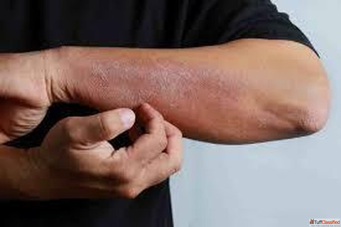 Recognizing the Common Symptoms of Eczema