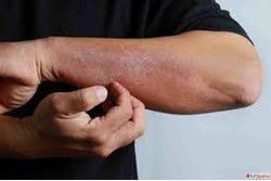 Recognizing the Common Symptoms of Eczema