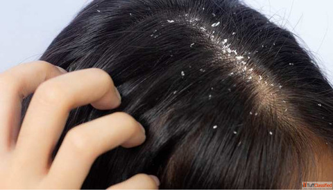 How Dandruff Affects Hair Growth and Loss