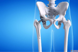 Revision Hip Replacement by Dr. Ajaysinh Devda