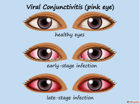 Clear Your Eyes with Homeopathic Conjunctivitis Treatment